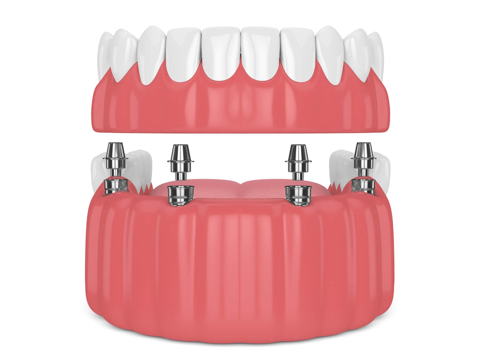 What is an Overdenture and what are its benefits?