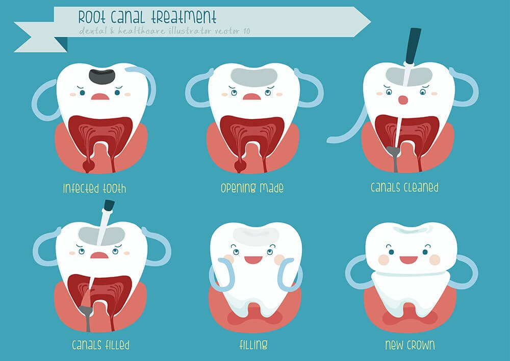 Root Canals Don’t Have to Be Scary