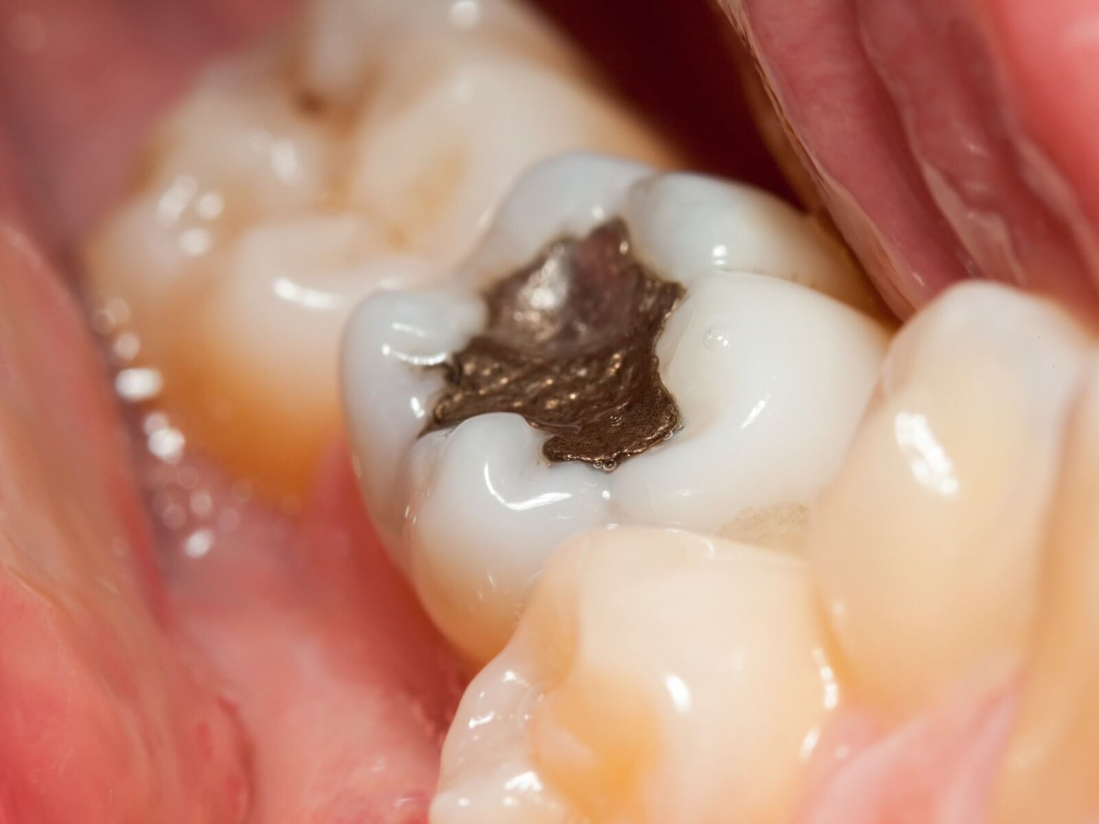 Are amalgam (silver) fillings safe?