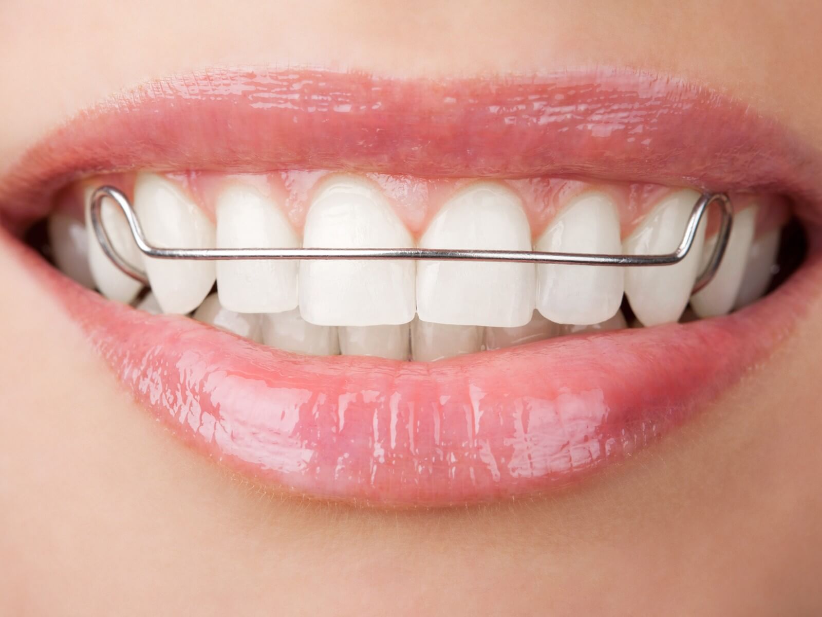 Can You Wear An Old Retainer To Straighten Teeth?