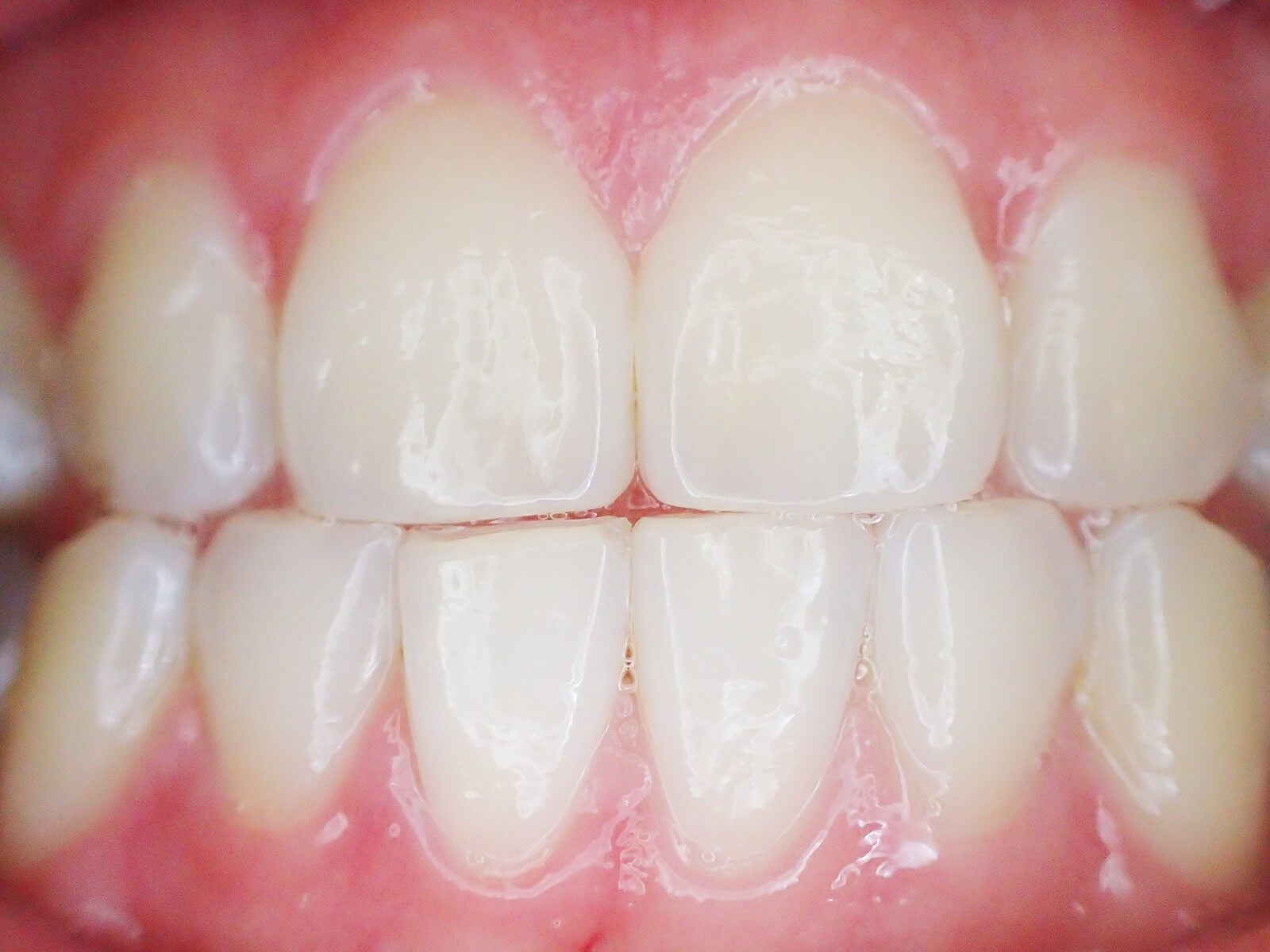 What are Mamelons on Teeth, and how to remove them?