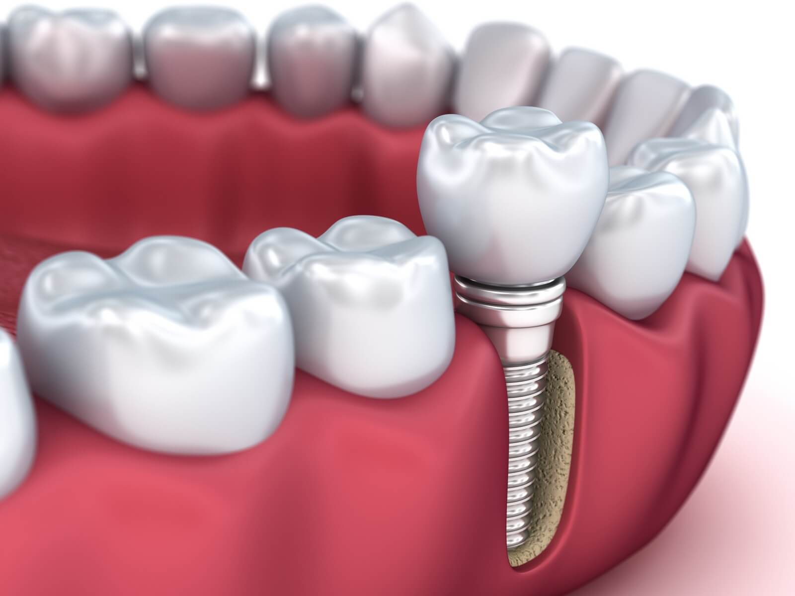 Options to Replace Missing Teeth