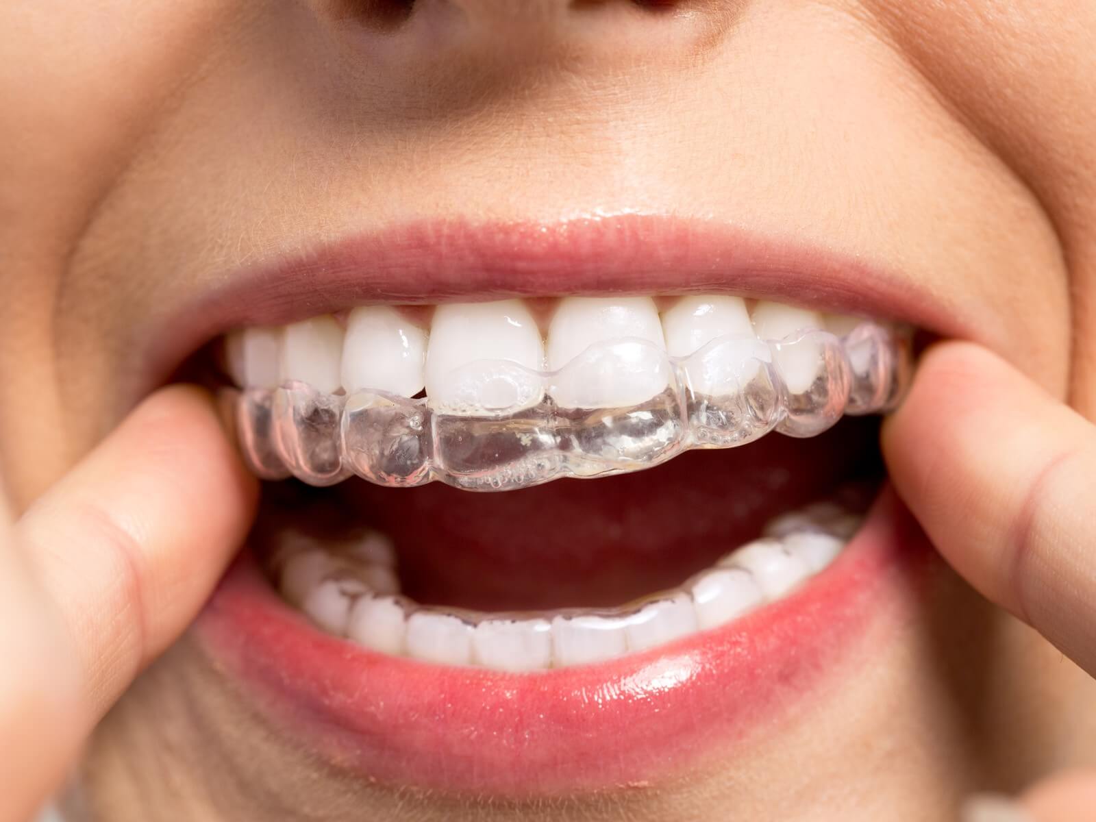 How painful is Invisalign?