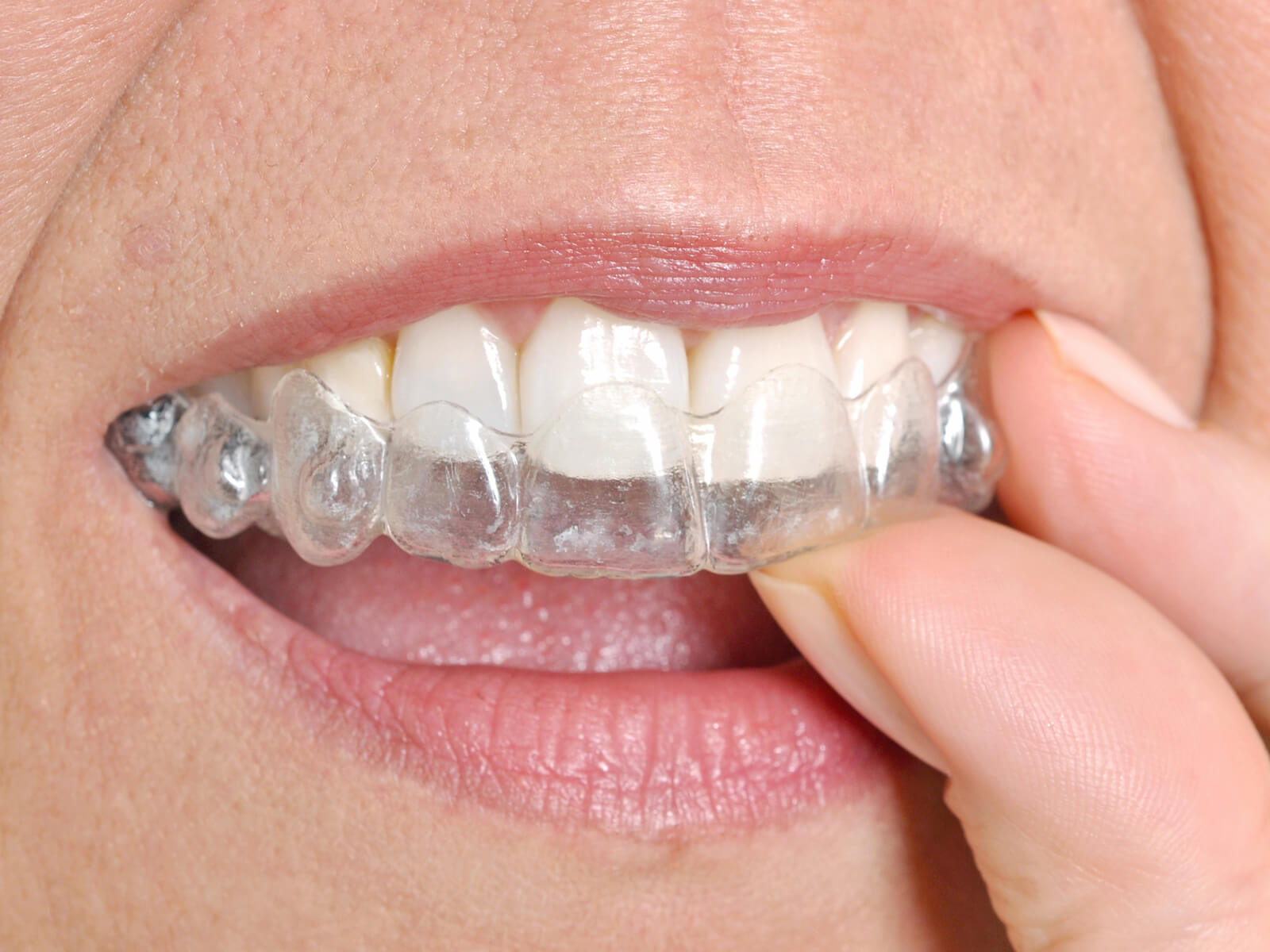 What is the difference between Invisalign and Invisalign lite?