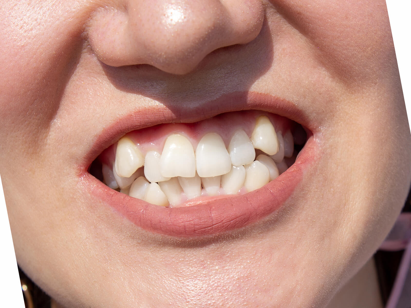 What Causes Alignment Issues For Your Teeth?