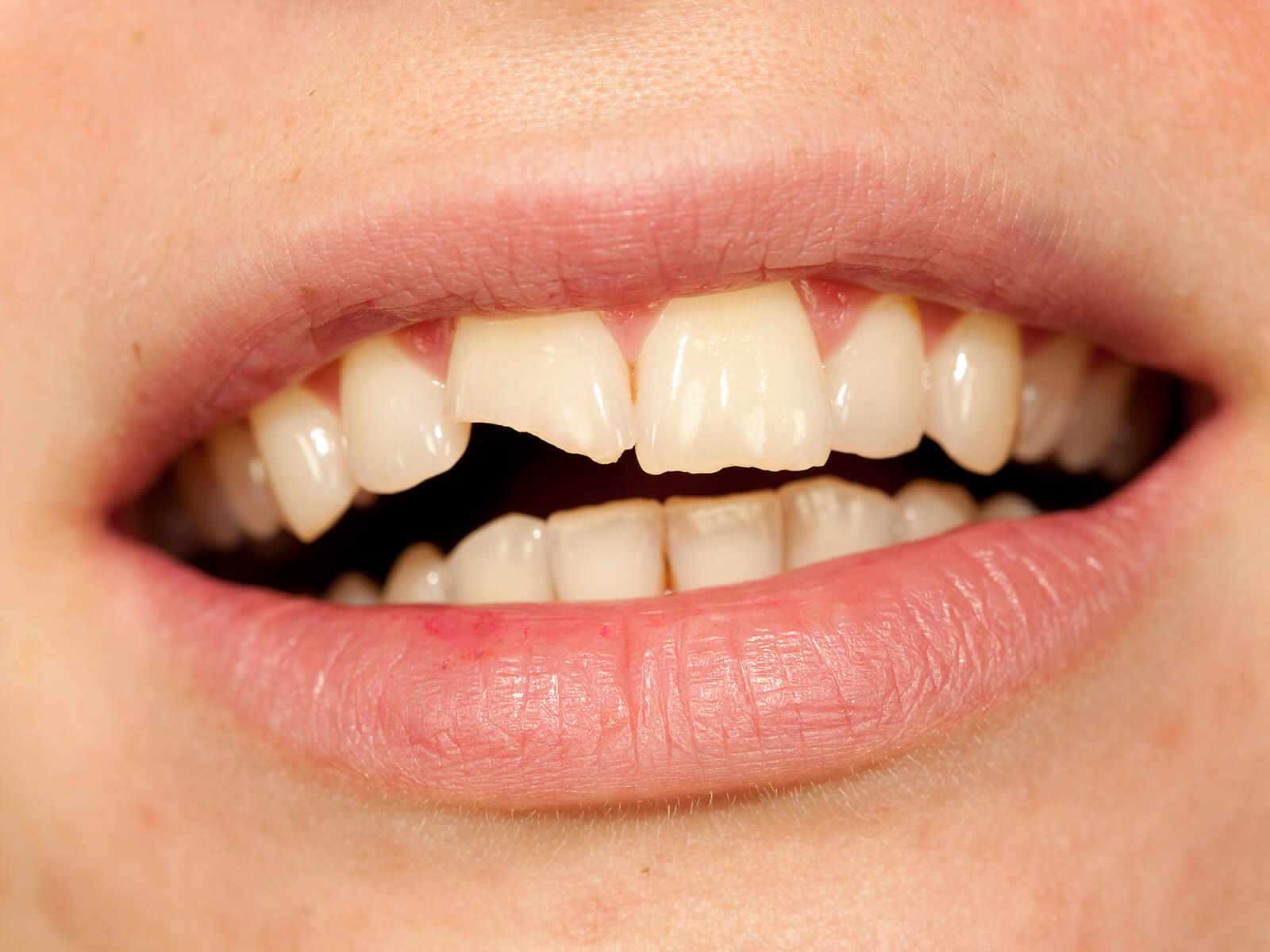 What Treatments Are Available for Broken Teeth?
