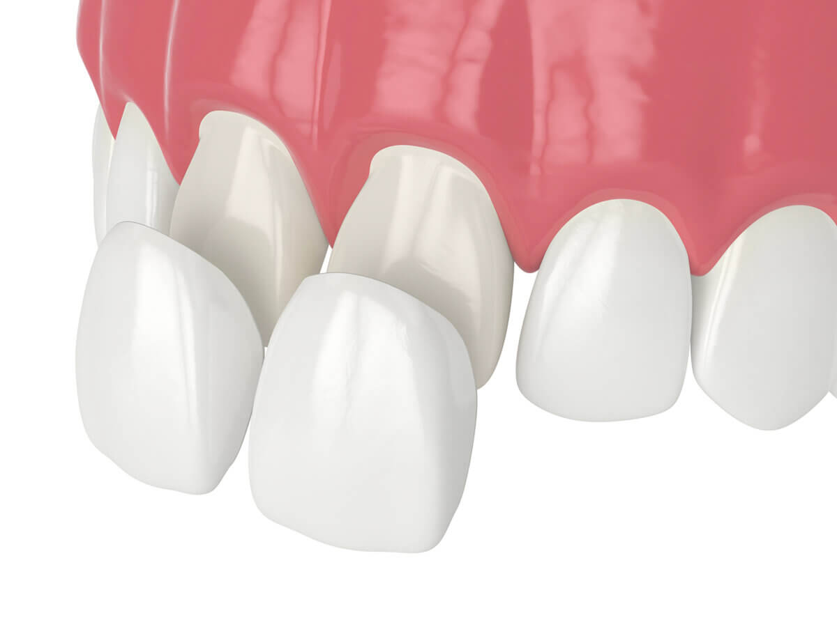 Does replacing veneers damage teeth?