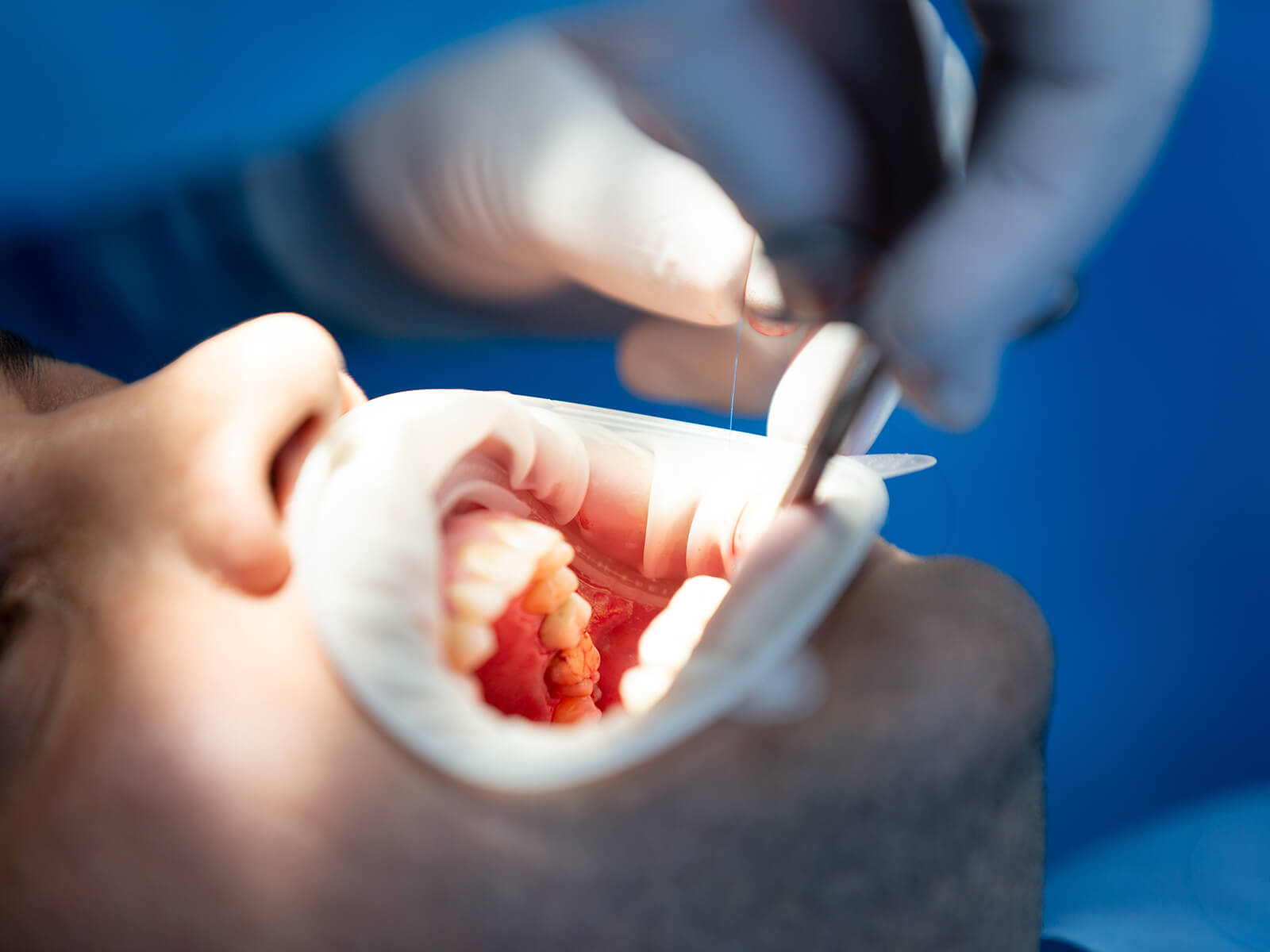 What You Need To Know About Osseous Surgery