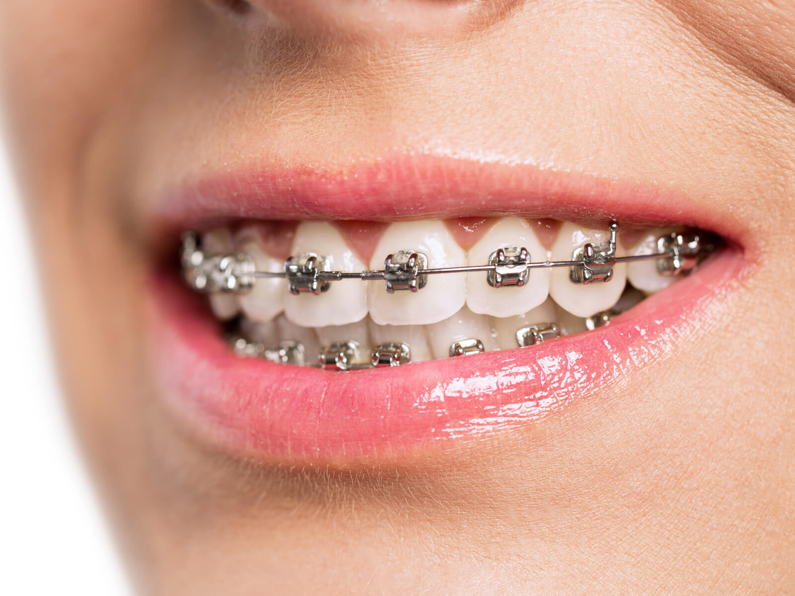 Pros and Cons of Traditional Metal Braces