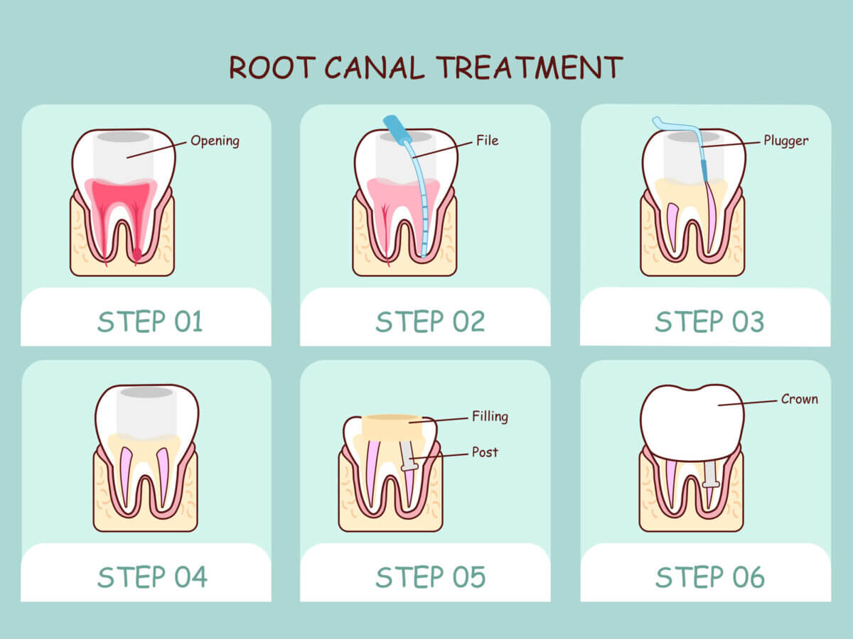 Types of Root Canal Treatment