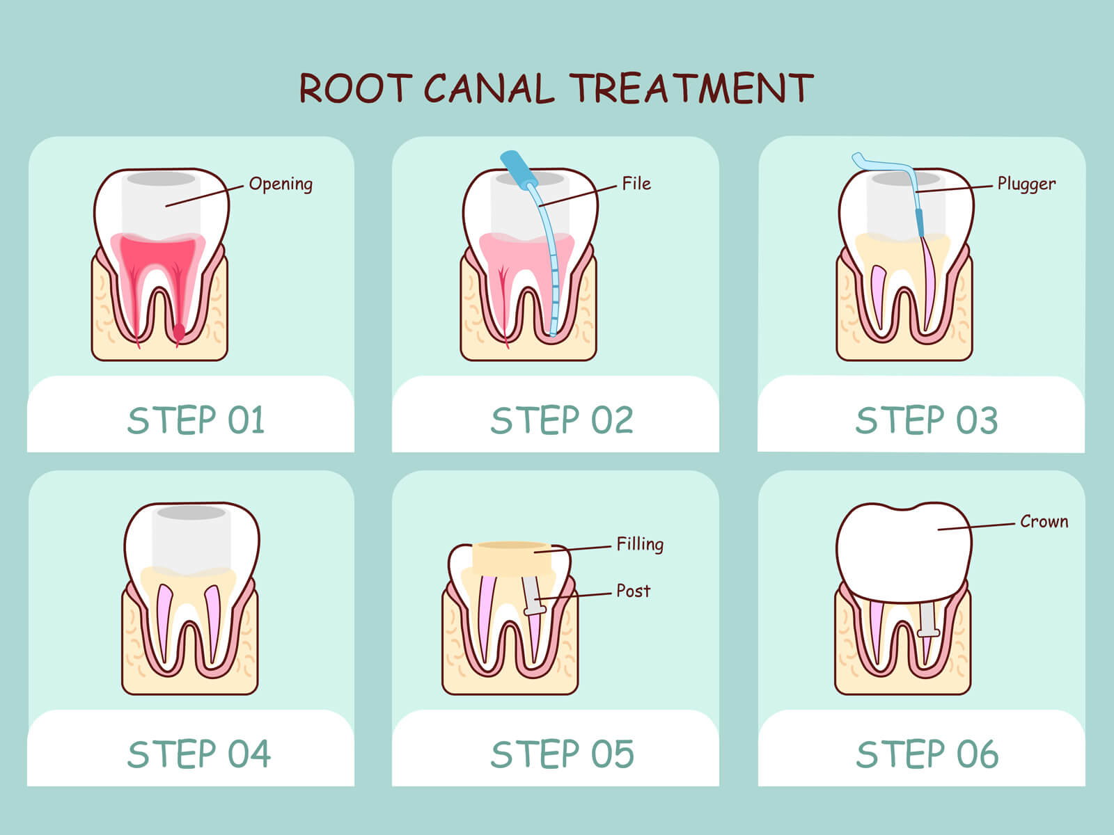 Types of Root Canal Treatment