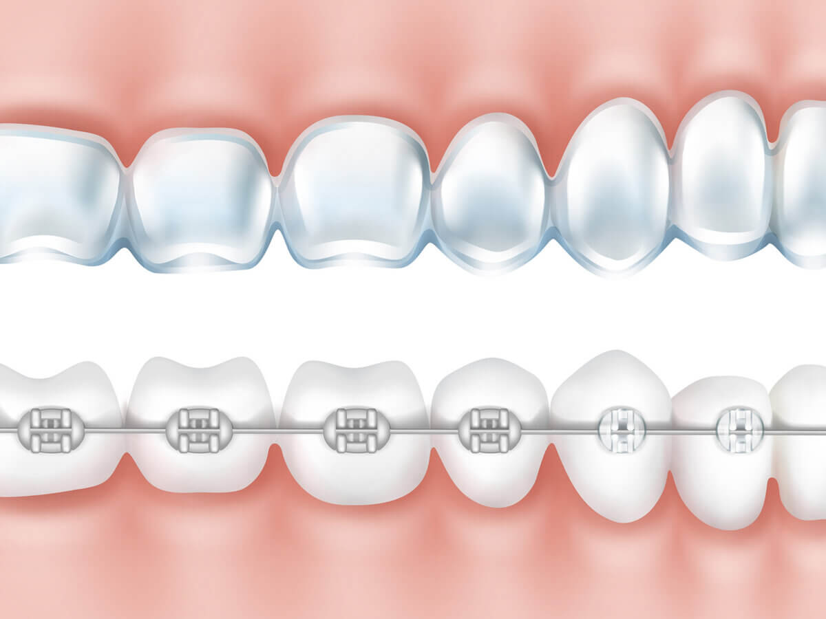7 Benefits of Invisalign Over Traditional Braces