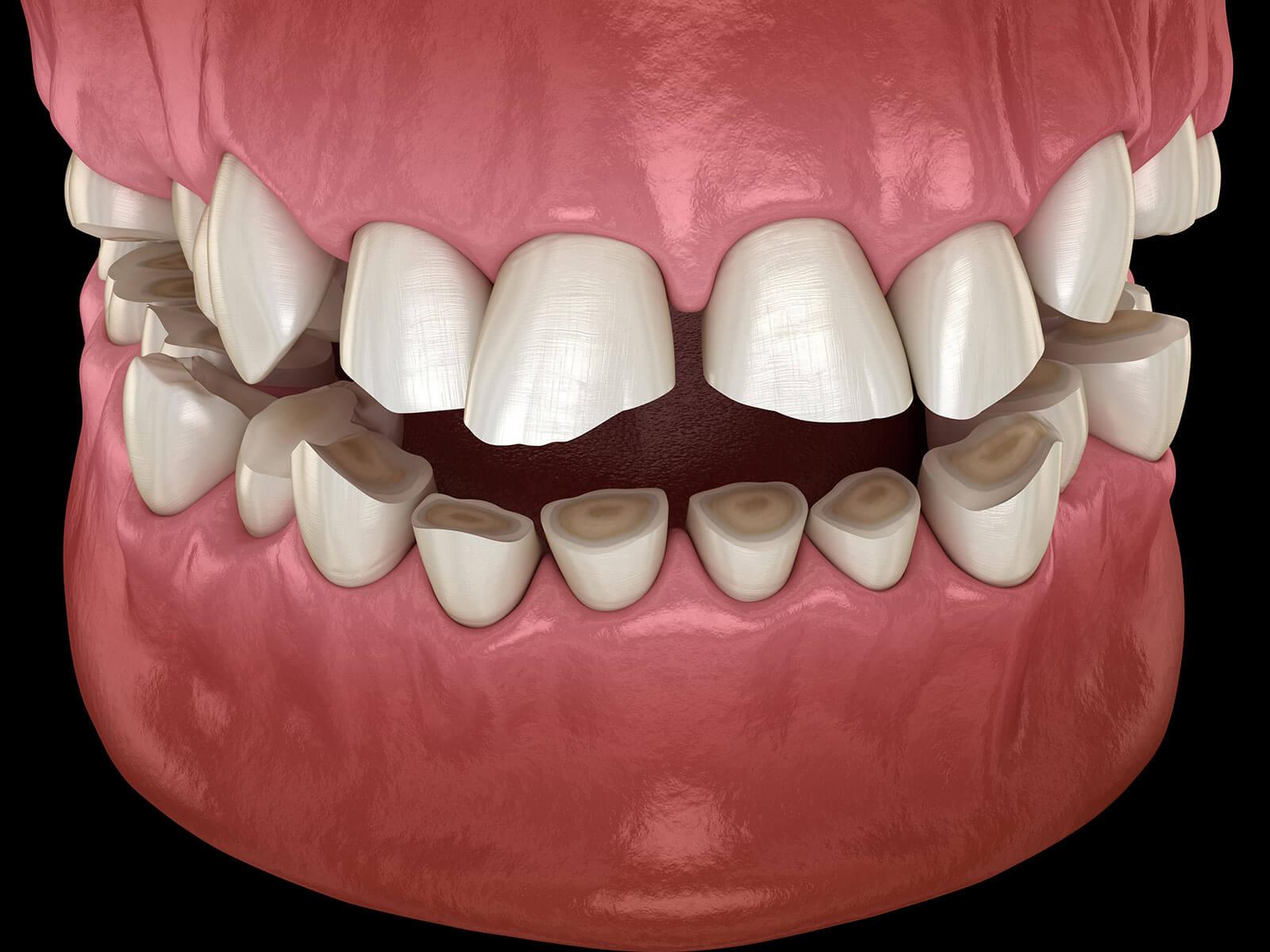 What Can I Do To Prevent Dental Erosion?