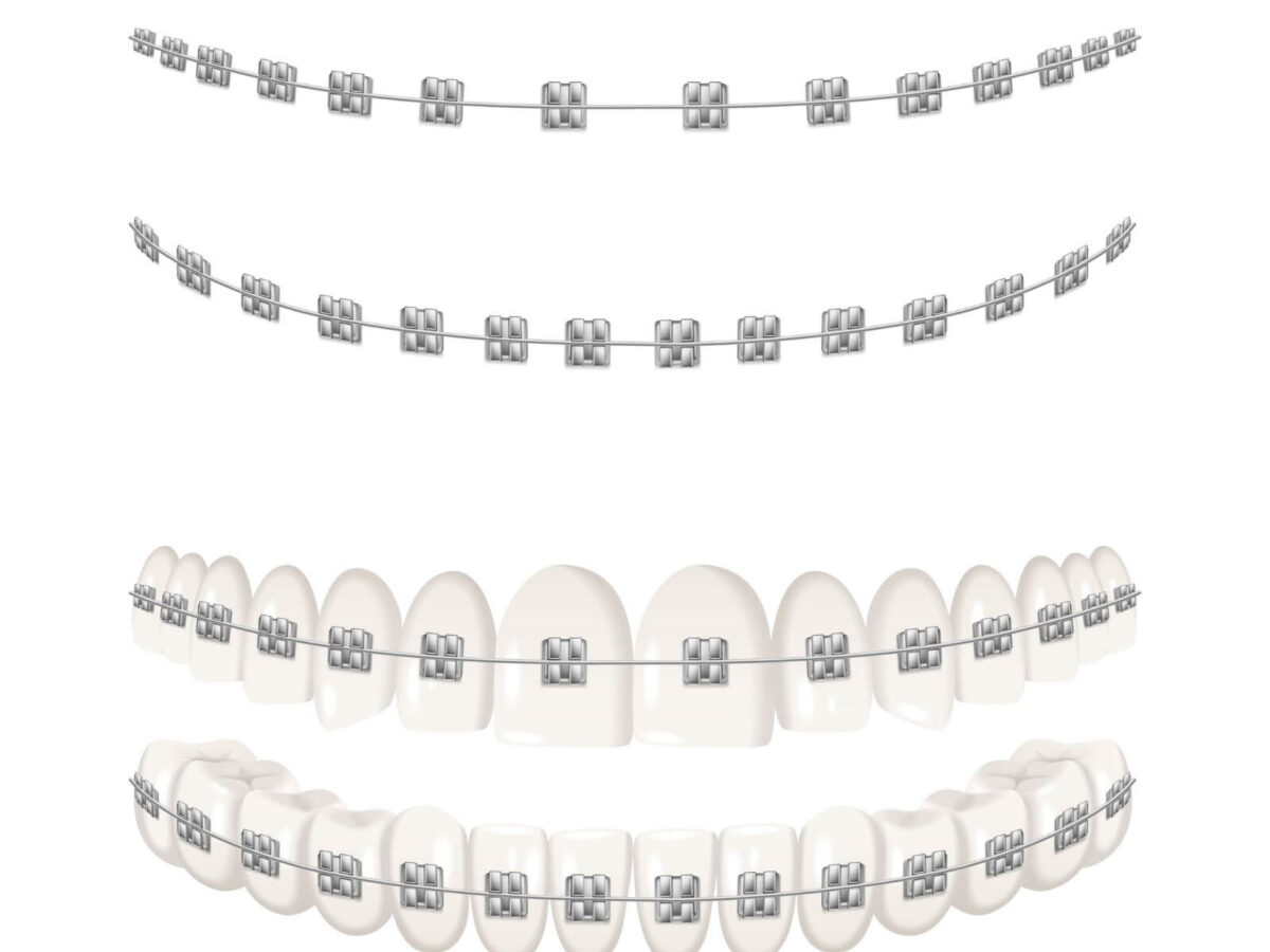 Can Braces or Aligners Correct Speech Impediments?