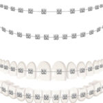 Can Braces or Aligners Correct Speech Impediments?