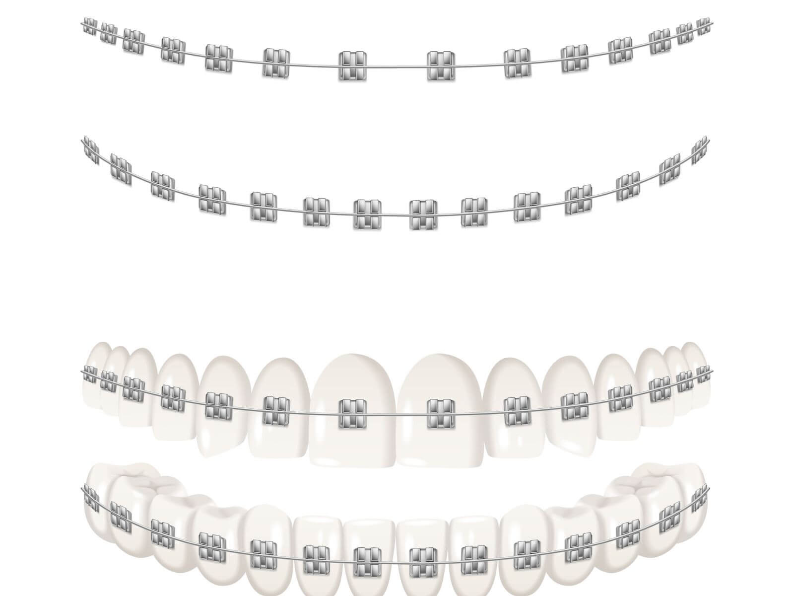 Can Braces or Aligners Correct Speech Impediments?