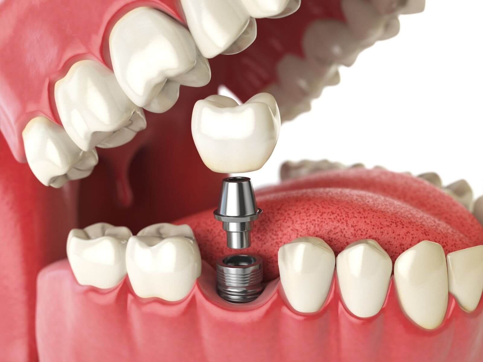 The Do’s And Don’ts of Living With Dental Implants
