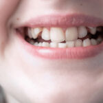 How To Fix Crooked Teeth Without Traditional Braces?