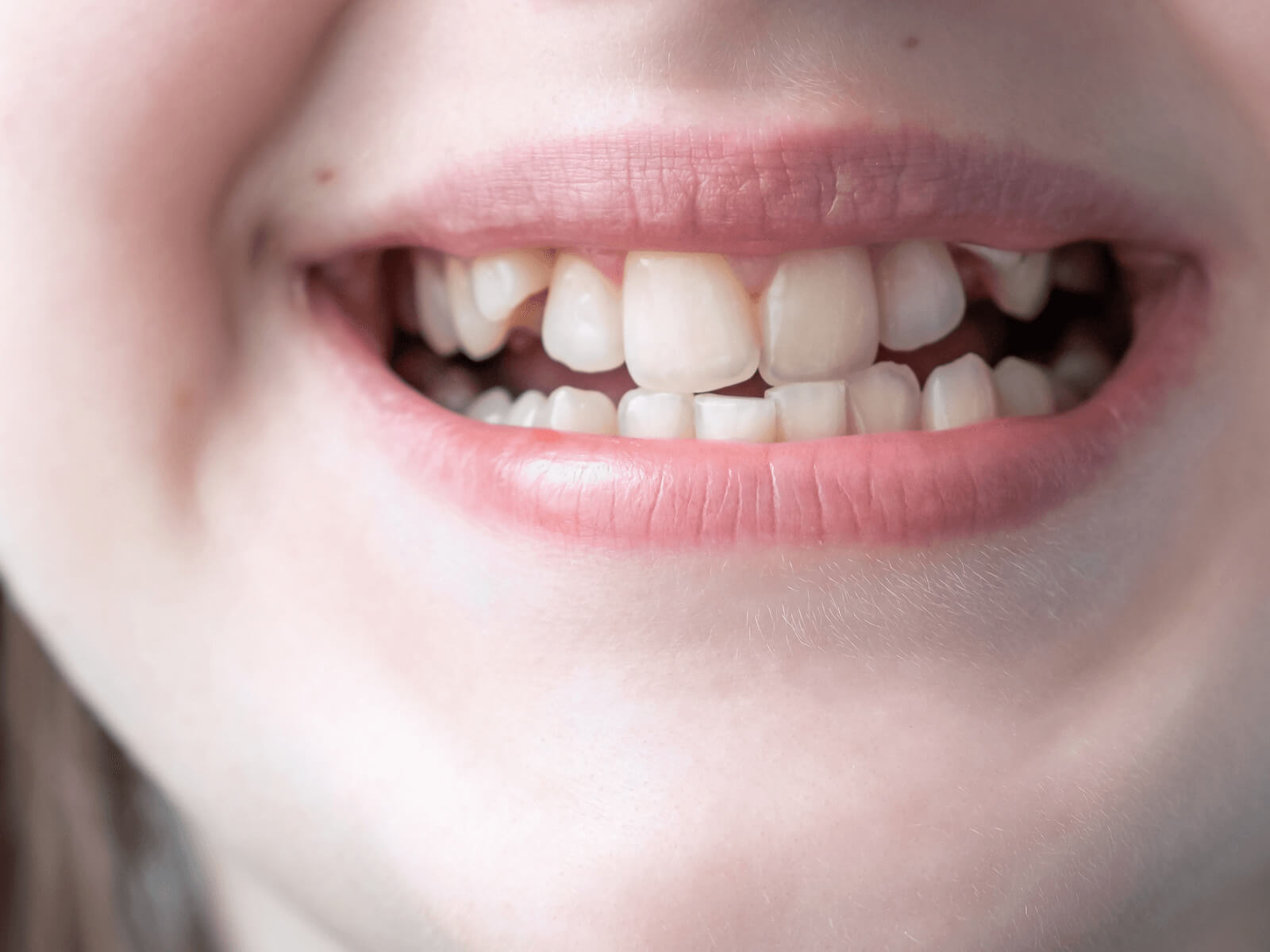 How To Fix Crooked Teeth Without Traditional Braces?