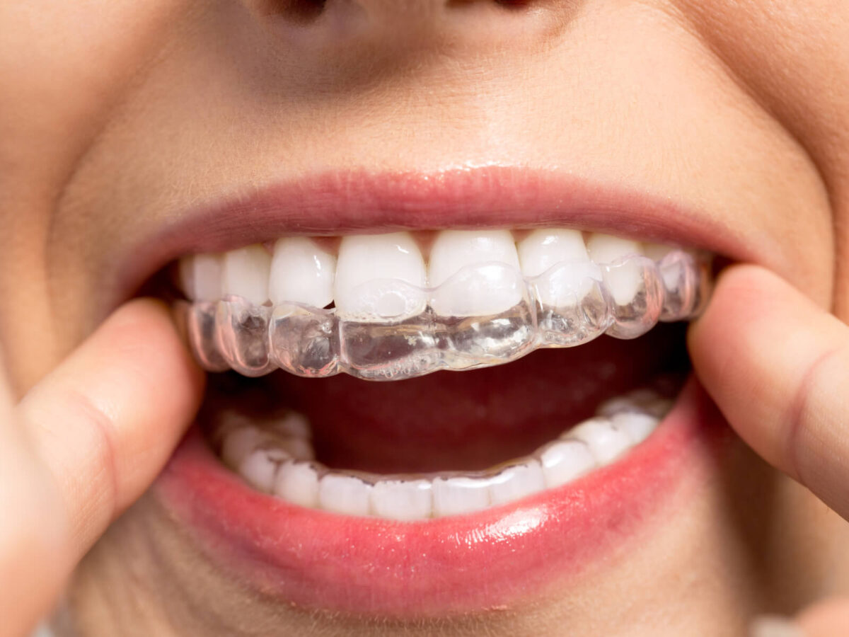 How Invisalign Can Transform Your Smile and Confidence