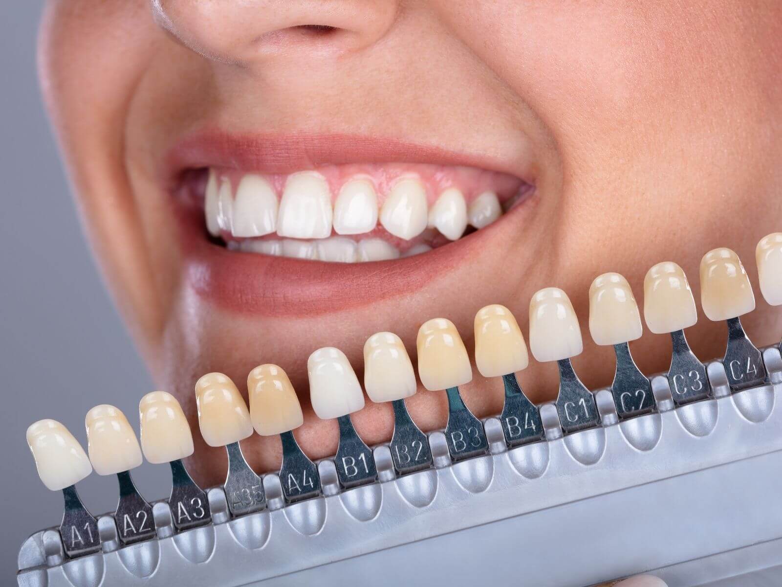 Teeth Whitening for Sensitive Teeth: Safe and Effective Methods