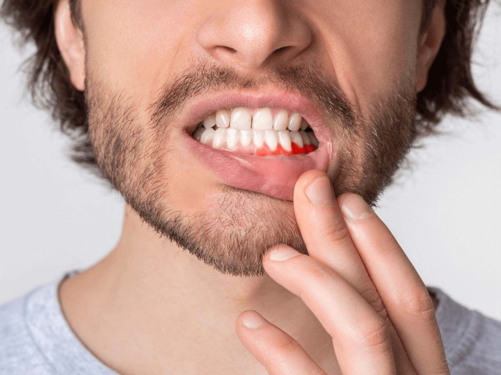 Dental Crowns vs Veneers: Differences, Benefits & Uses