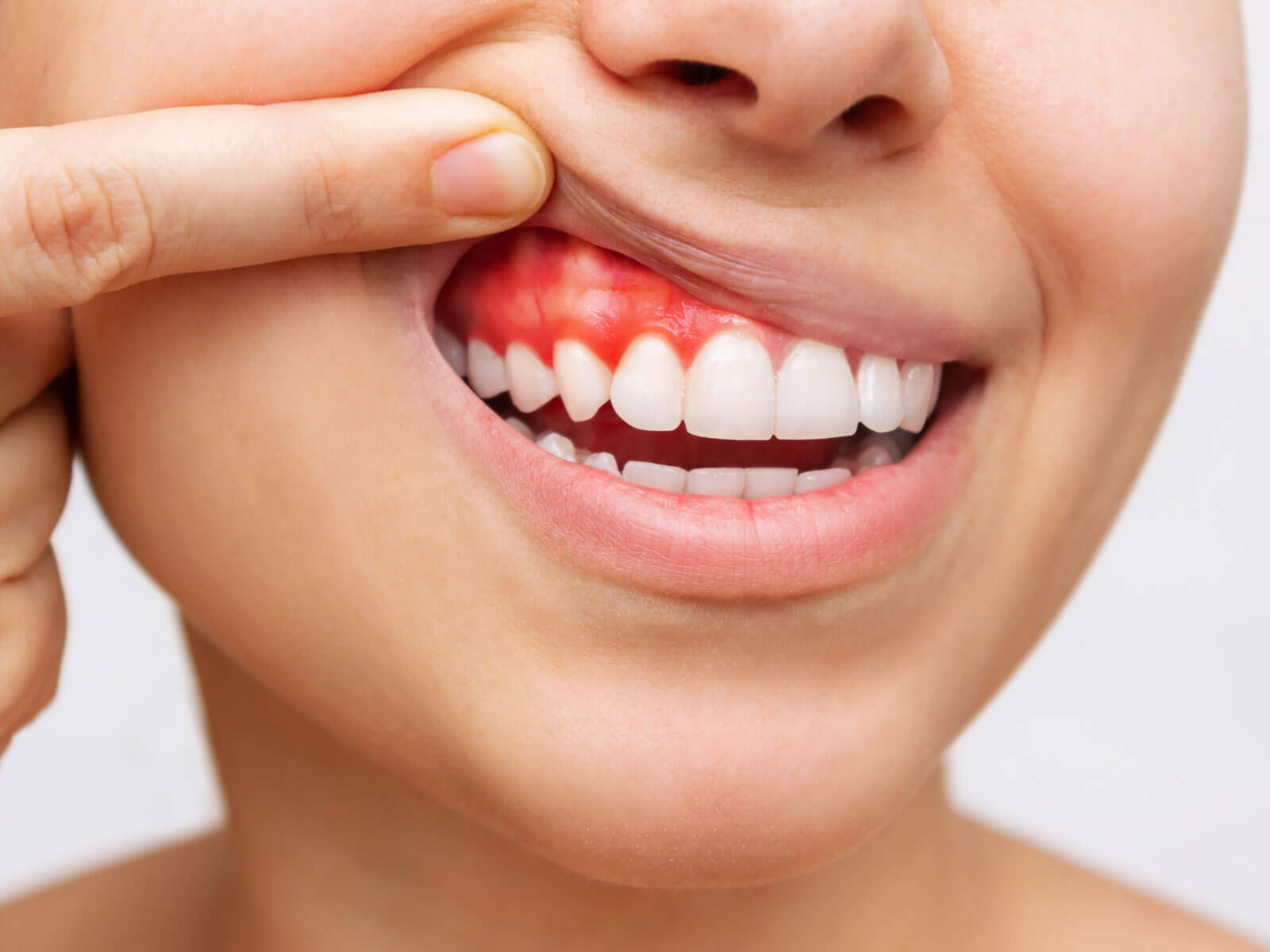 Gingival Enlargement Treatment: Options, Costs, and Recovery