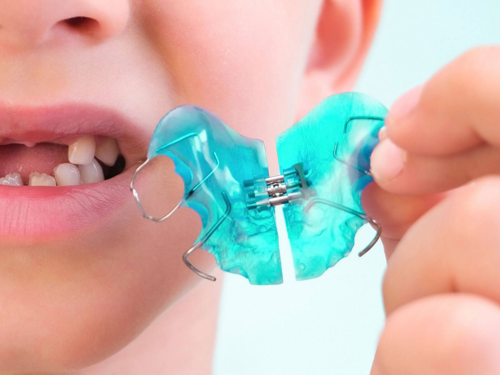 How Do Palatal Expanders Work? A Step-by-Step Explanation